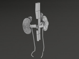Renal cell carcinoma Modelo 3D