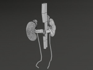 Renal cell carcinoma Modelo 3D