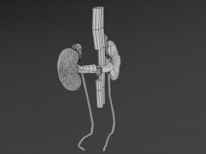 Renal cell carcinoma Modelo 3D