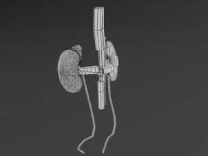 Renal cell carcinoma Modelo 3D