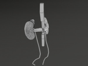 Renal cell carcinoma Modelo 3D