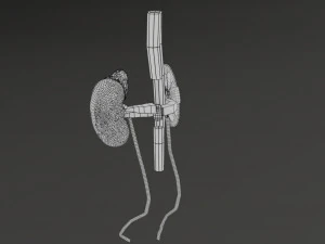Renal cell carcinoma 3D Model