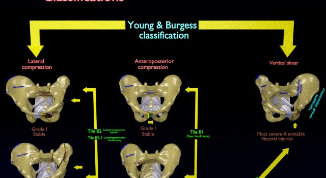 Pelvis fractures 3D Model .c4d .max .obj .3ds .fbx .stl .blend 