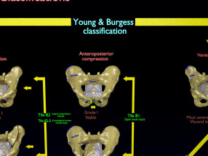 Pelvis fractures 3D Model