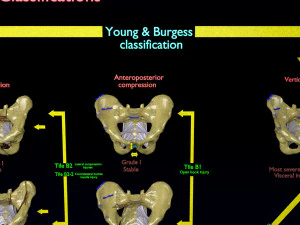 Fraturas da pelve Modelo 3D