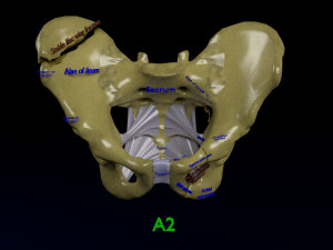 Pelvis fractures 3D Model