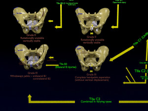 Pelvis fractures 3D Model