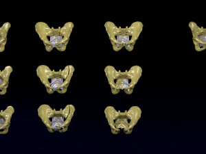 Fraturas da pelve Modelo 3D