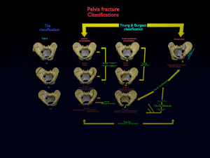 Pelvis fractures 3D Model