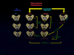 Fraturas da pelve Modelo 3D