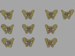 Fraturas da pelve Modelo 3D