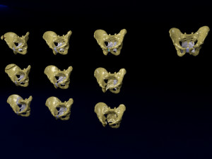 Pelvis fractures 3D Model
