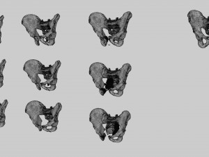 Pelvis fractures 3D Model