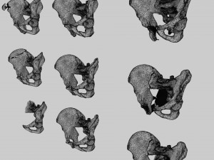 Pelvis fractures 3D Model