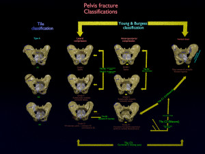 Pelvis fractures 3D Model