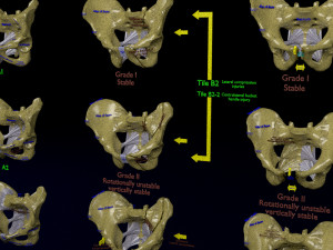Pelvis fractures 3D Model