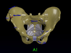 Pelvis fractures 3D Model