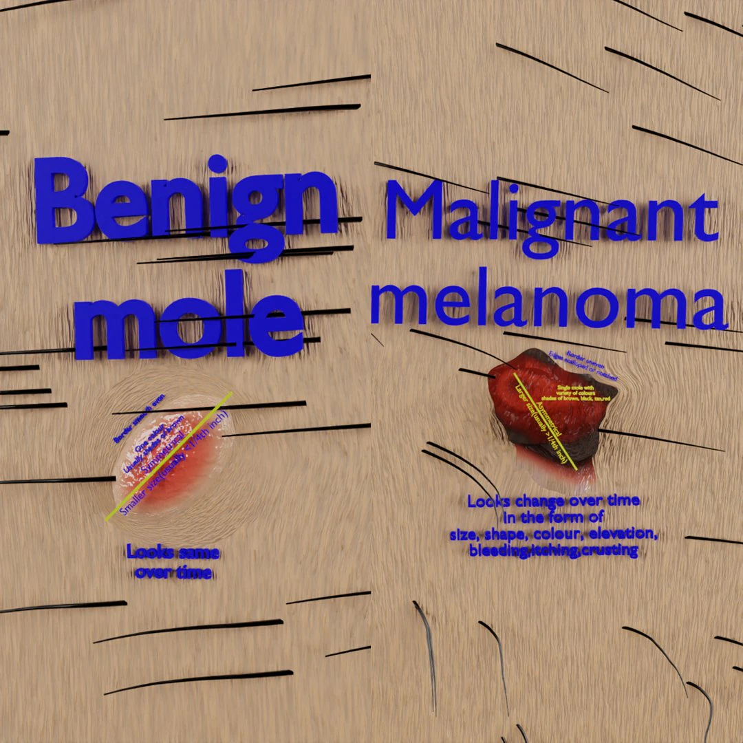Mole nevus cancer Malignant melanoma differences 3D 3D Model .c4d .max .obj .3ds .fbx .stl .blend 