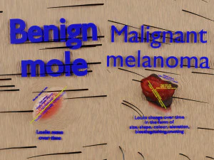 두더지 모반암 악성 흑색종 차이 3D 3D 모델