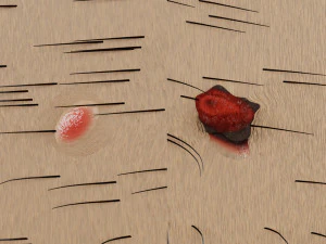 Mole nevus cancer Malignant melanoma differences 3D 3D Model