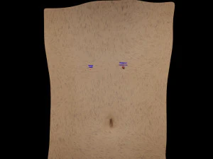 Mole nevus cancer Malignant melanoma differences 3D 3D Model