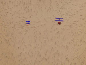 Mole nevus cancer Malignant melanoma differences 3D 3D Model