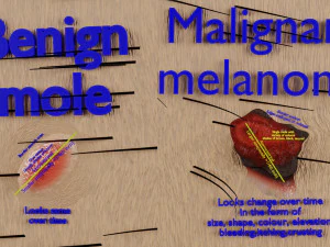 Mole nevus cancer Malignant melanoma differences 3D 3D Model
