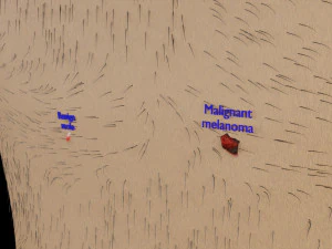 Mole nevus cancer Malignant melanoma differences 3D 3D Model