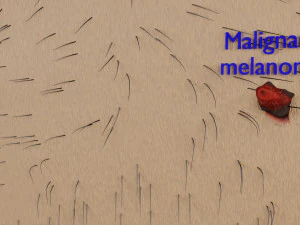 Mole nevus cancer Malignant melanoma differences 3D 3D Model