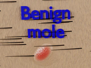 Mole nevus cancer Malignant melanoma differences 3D 3D Model