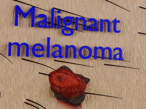Mole nevus cancer Malignant melanoma differences 3D 3D Model