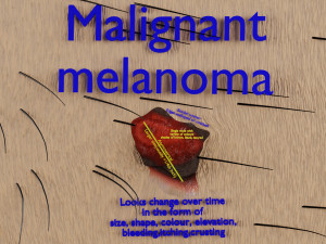 Mole nevus cancer Malignant melanoma differences 3D Model 3D