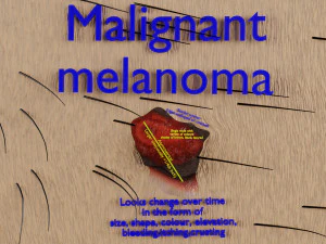 Mole nevus cancer Malignant melanoma differences 3D 3D Model