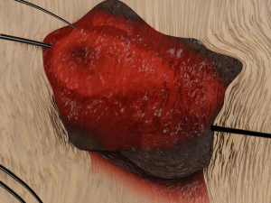 Mole nevus cancer Malignant melanoma differences 3D 3D Model