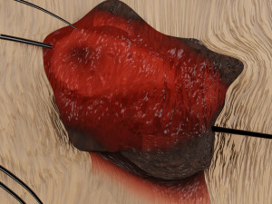 Mole nevus cancer Malignant melanoma differences 3D Model 3D