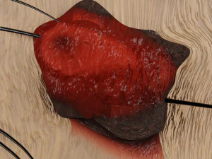 Mole nevus cancer Malignant melanoma differences 3D 3D Model