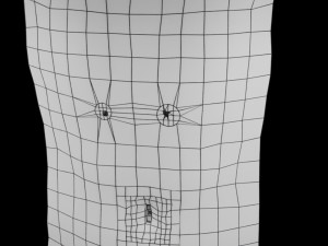 Mole nevus cancer Malignant melanoma differences 3D Model 3D