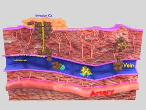 3 boyutlu kanser metastazı yayılma modeli 3D Model