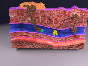3D cancer metastasis spread model Modelo 3D