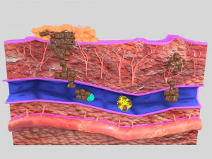 3D cancer metastasis spread model 3D Model