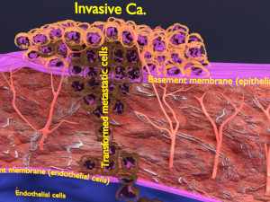 3D cancer metastasis spread model Modelo 3D