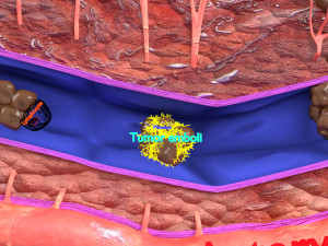 3D cancer metastasis spread model Modelo 3D
