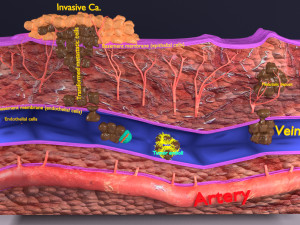 3D cancer metastasis spread model Modelo 3D