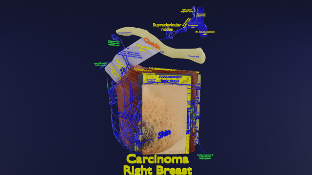 Breast Cancer types spread labelled detail Modelo 3D .c4d .max .obj .3ds .fbx .stl .blend 
