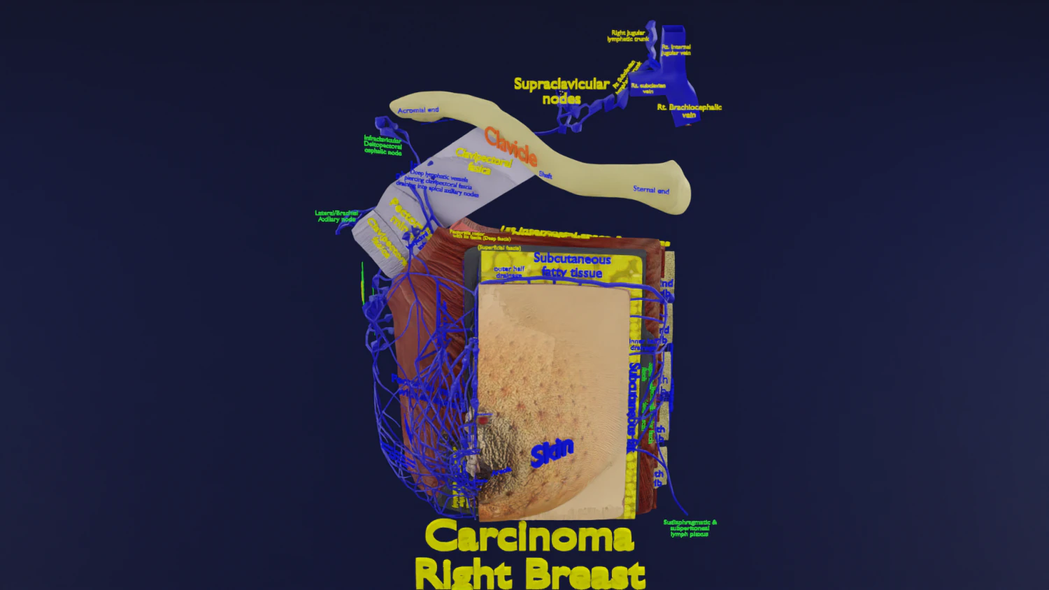 Breast Cancer types spread labelled detail 3D Model .c4d .max .obj .3ds .fbx .stl .blend 