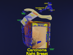 Breast Cancer types spread labelled detail 3Dモデル