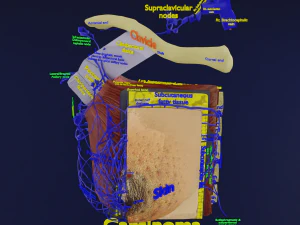 Breast Cancer types spread labelled detail 3D Model