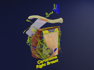 Breast Cancer types spread labelled detail Modelo 3D