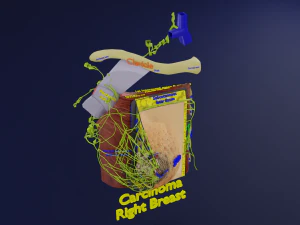 Breast Cancer types spread labelled detail 3D Model