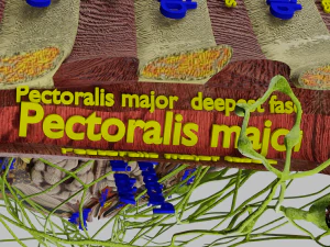 Breast Cancer types spread labelled detail 3D Model